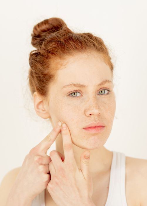 Zabieg Skin Storm dla cery trądzikowej w Velissi Beauty Clinic.