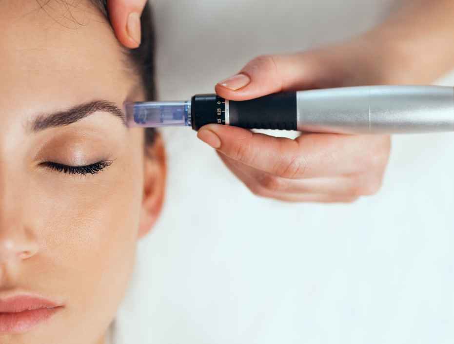 Dermapen na rozstępy we wrocławskim salonie kosmetycznym.
