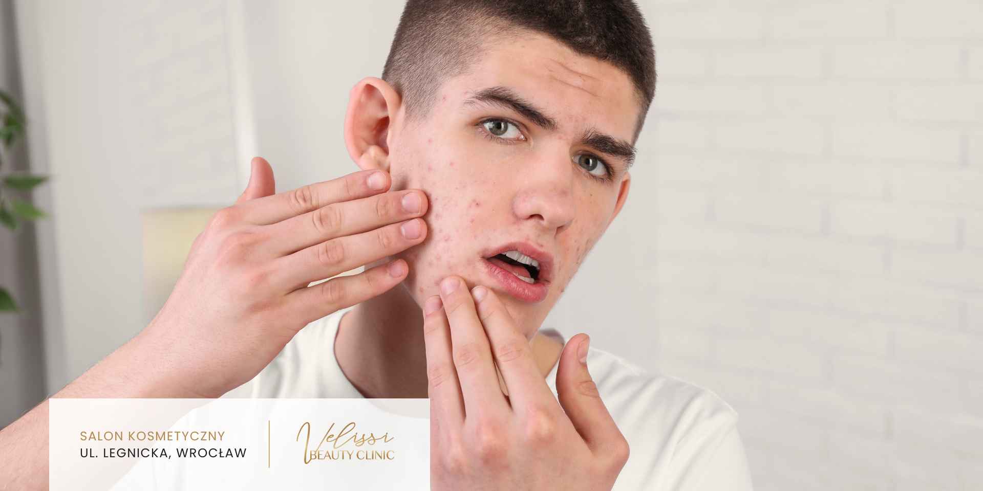 Skóra mężczyzny ze skłonnościami do trądziku przed zabiegiem radiofrekwencji mikroigłowej