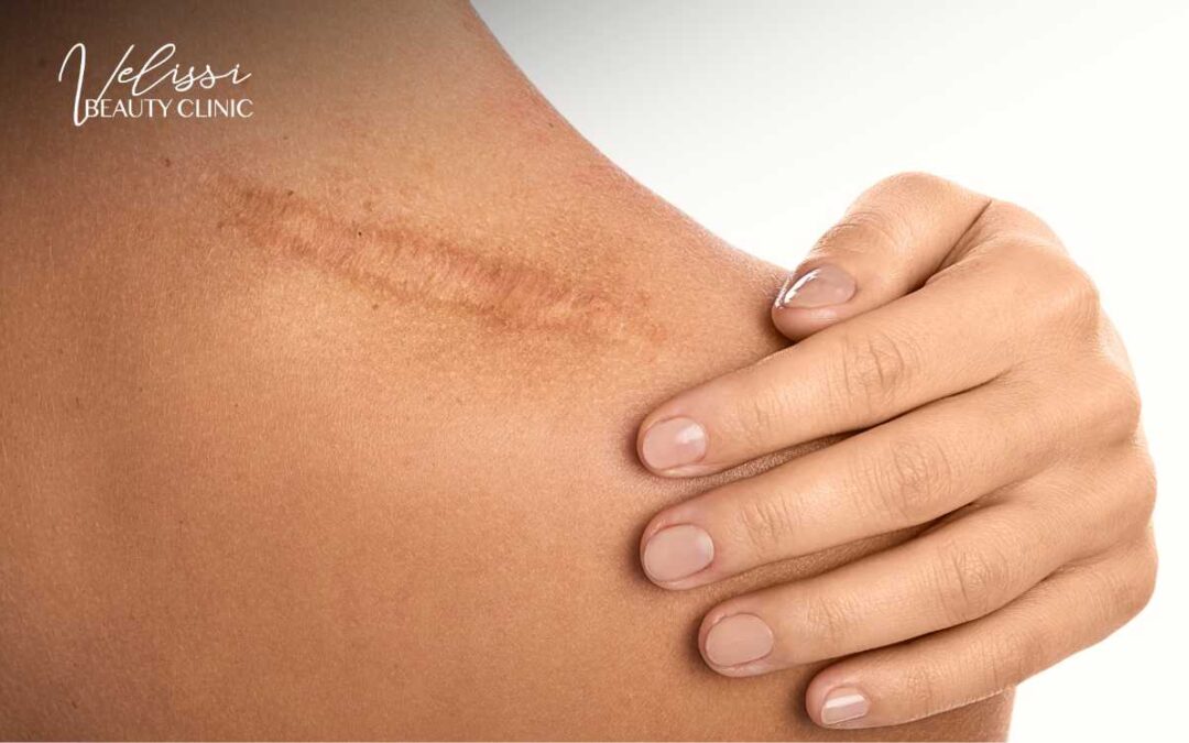 Blizna na plecach klientki Velissi Beauty Clinic